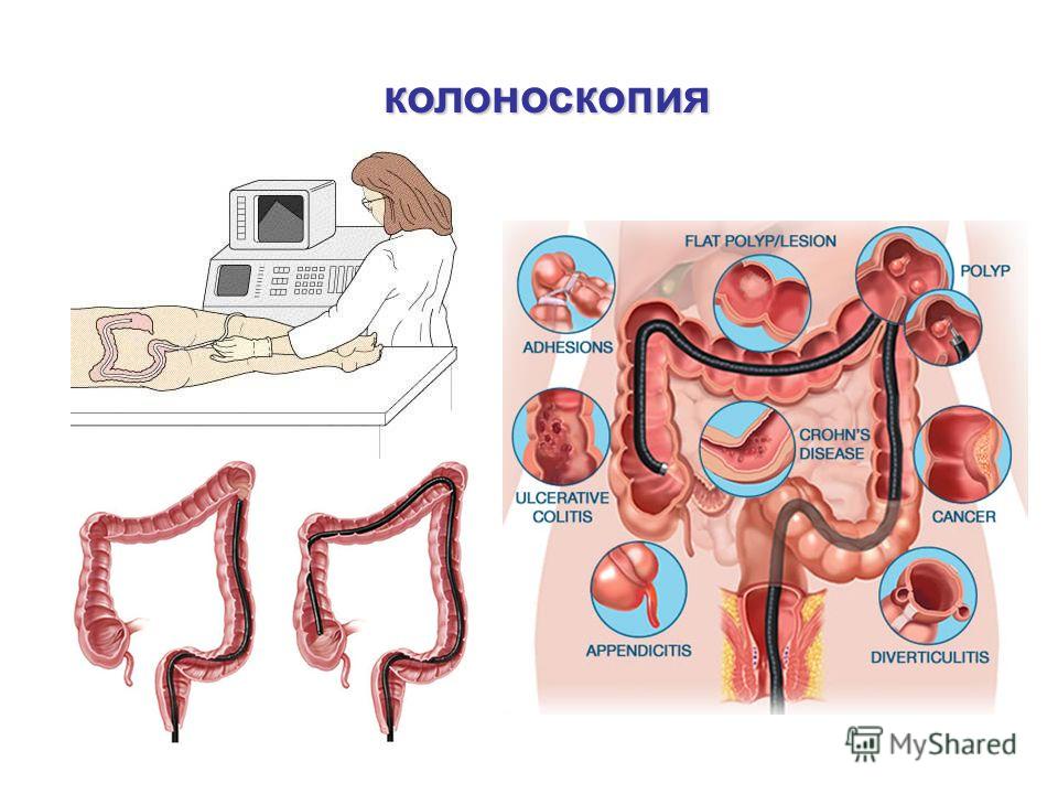 Процесс колоноскопии. Колоноскопии кишечника. Колоноскопия кишечника.