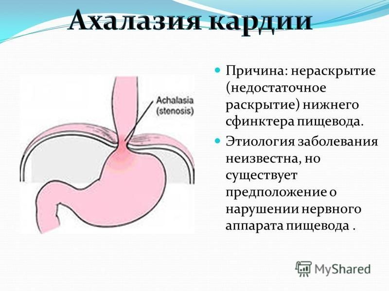 Эндоскопические признаки кардии. Нижний эзофагеальный сфинктер. Нижний пищеводный сфинктер. Нижний пищеводный сфинктер смыкается.