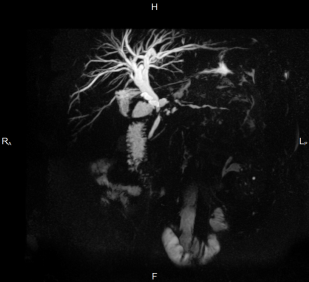 Пример снимака МРТ-холангиографии