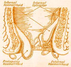 This picture / diagram of hemroids, shows what external, internal and prolapsed internal hemorrhoids are.