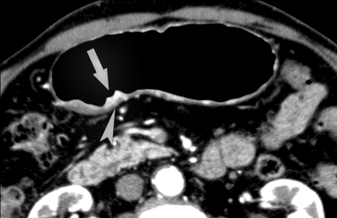 Онкология желудка 4 стадия. Раковая опухоль изнутри. Разложение опухоли фото. Фото хористомы желудка.