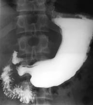 Рентген желудка