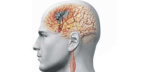 стеноз сосудов головного мозга
