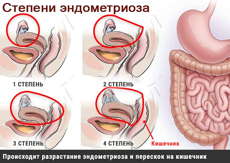 Лечение эндометриоза кишечника в Москве стоимость