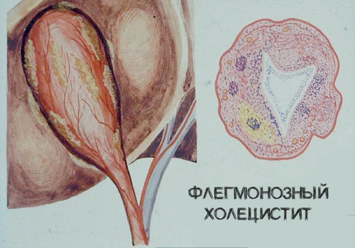 флегмонозный холецистит