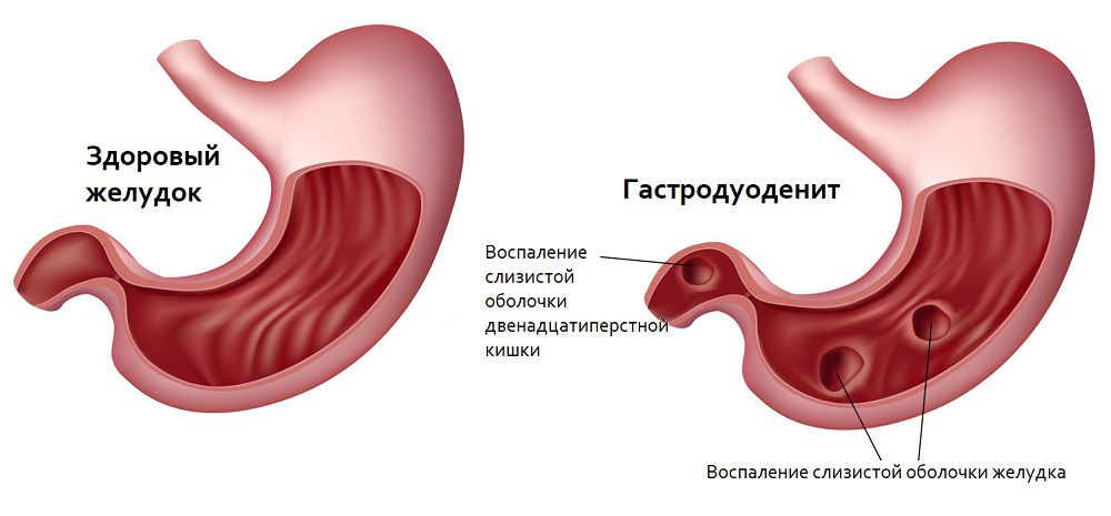 Презентация гастрит и дуоденит