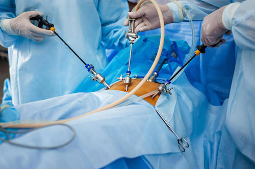 Лапароскопия аппендицита: цены на операцию