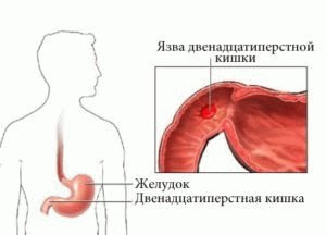 Язва двенадцатиперстной кишки