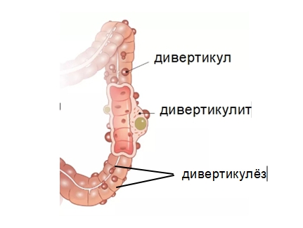 Дивертикулит что. Дивертикулы сигмовидной кишки. Дивертикул Толстого кишечника этиология. Дивертикулярная болезнь толстой кишки хирургия. Дивертикулез этиология.