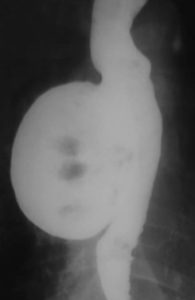 Дивертикул пищевода на рентгеновском снимке