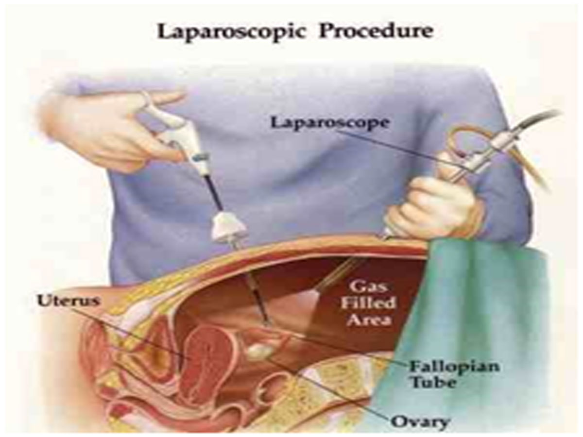 Лапароскопия кисты яичника швы