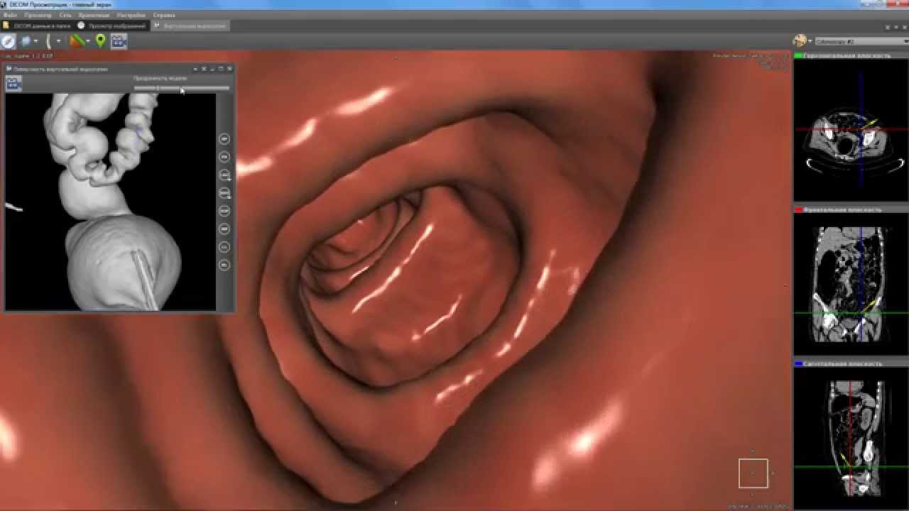 Виртуальная колоноскопия. Дивертикулит виртуальная колоноскопия. Здоровый кишечник колоноскопия.