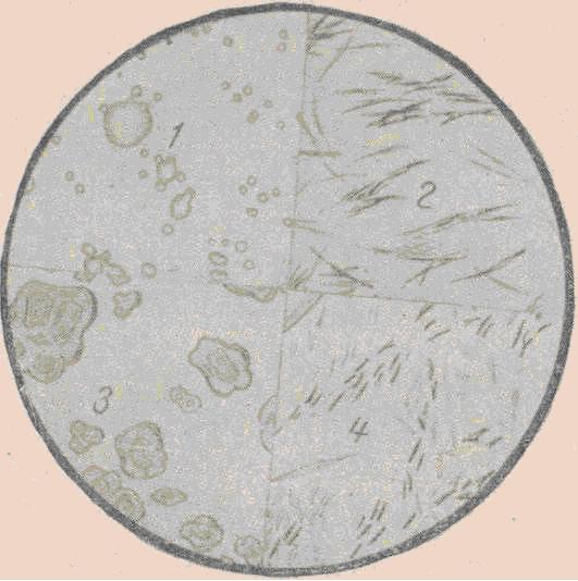 Растительная клетчатка в кале что значит. Копрология кала микроскопия. Микроскопия кала растительная клетчатка непереваримая. Микроскопия кала атлас копрология. Микроскопия копрограммы.