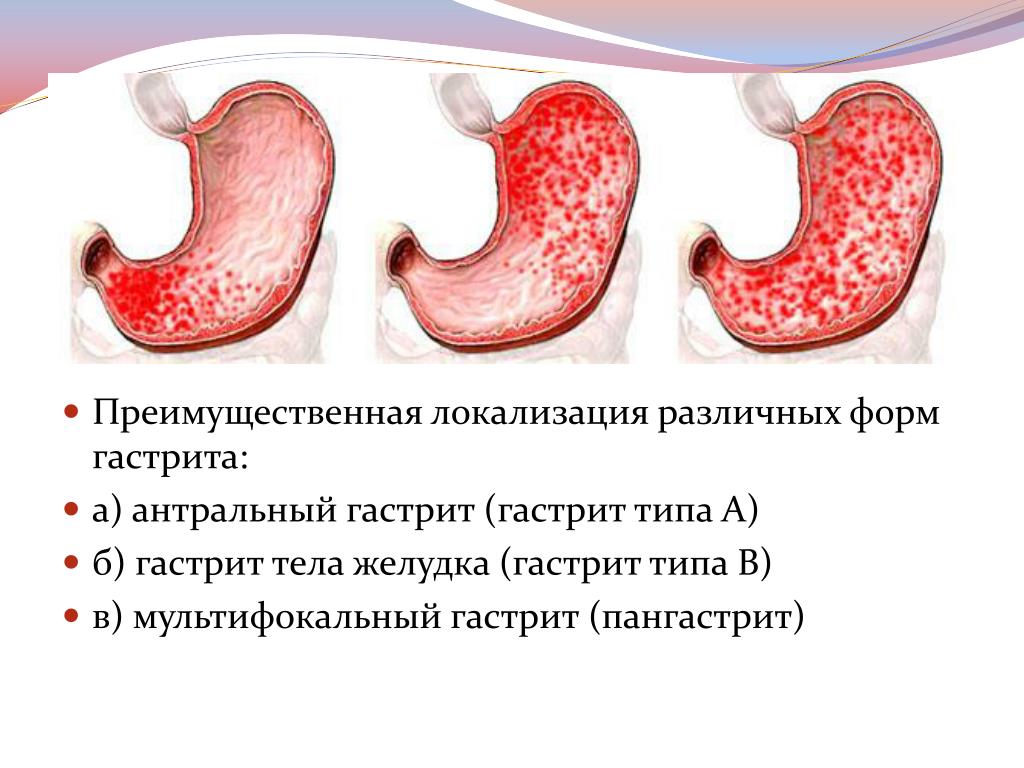 Виды хронического гастрита. Ригидный антральный гастрит схема. Хронич антральный гастрит. Гастрит типа в локализуется в отделе желудка:. Хронический антральный гастрит (Тип б).
