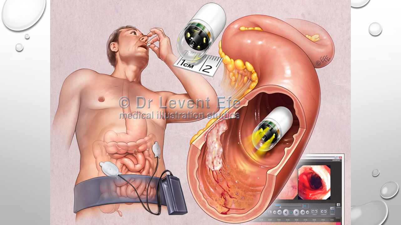 Процедура эндоскопия кишечника