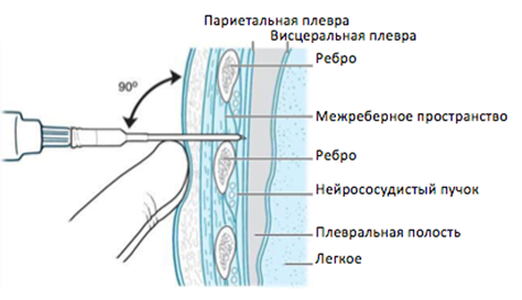 Плевральная пункция рисунок