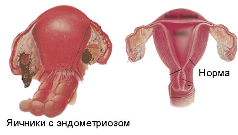 Яичники с эндометриозом и здоровые