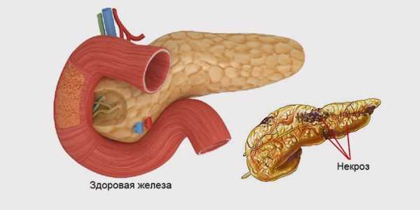Что такое панкреонекроз
