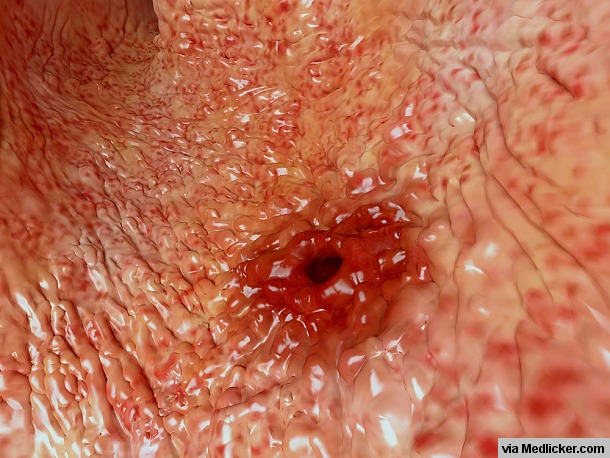 Peptic-Ulcer
