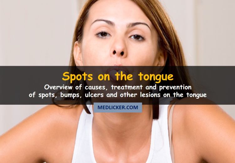 Why You Get Spots On Tongue And How To Get Rid Of Them