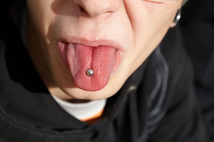 Tongue piercing is a common cause of spots, bumps and inflammation of the tongue