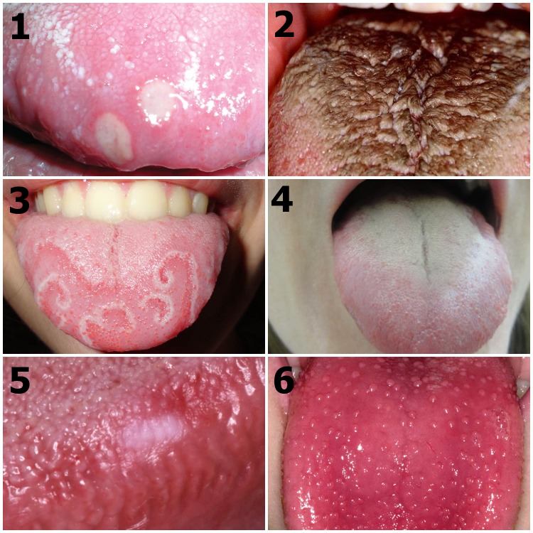 Spots and lesions on tongue: different common presentations