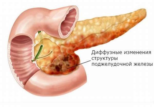 Диффузные изменения поджелудочной железы