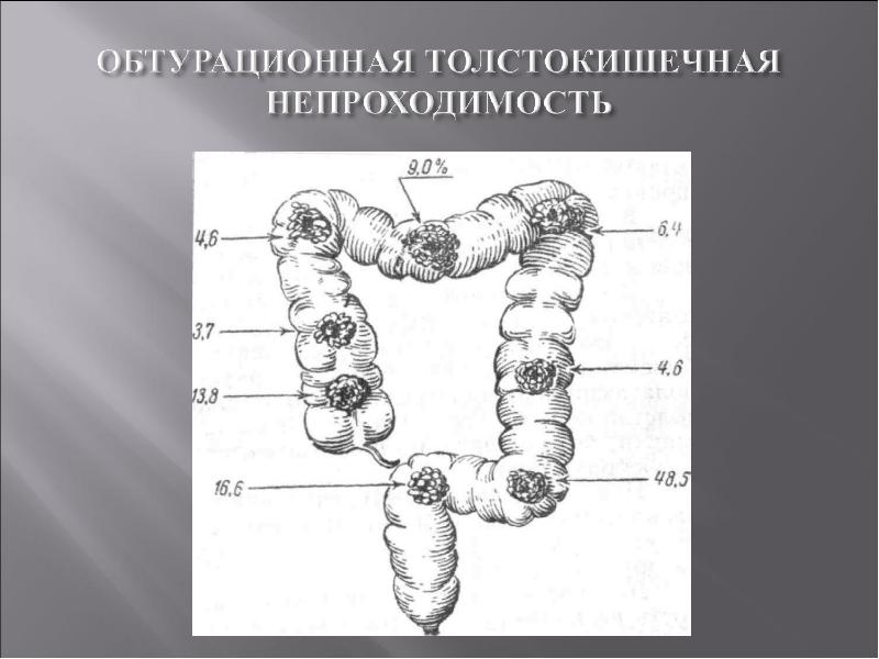 Обтурационная форма рака. Кишечная непроходимость толстой кишки. Обтурационную кишечной непроходимости. Острая обтурационная кишечная непроходимость. Обтурационная опухолевая толстокишечная непроходимость.