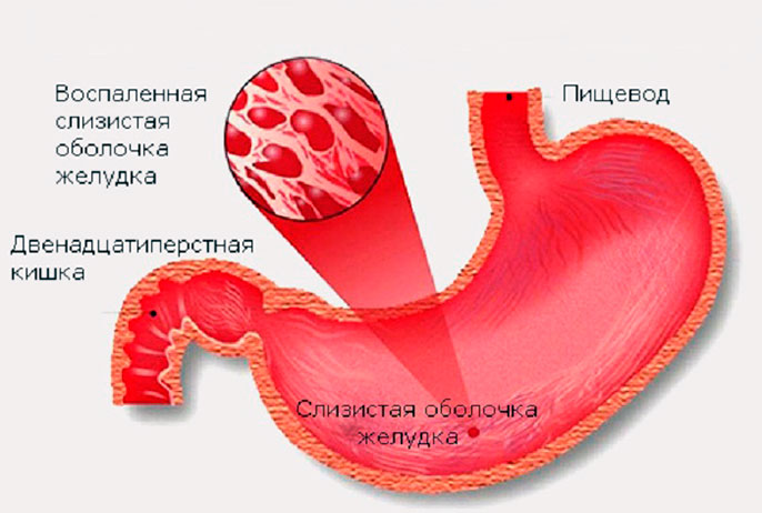 Хронический активный поверхностный гастрит