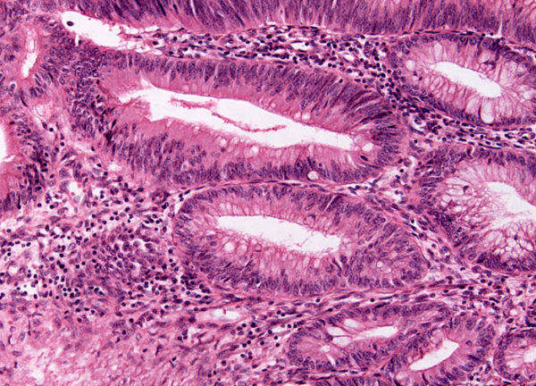 Гистология раковой опухоли кишечника