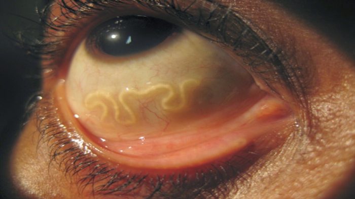 черви могут проникать в глазное яблоко