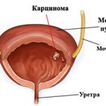 Карцинома мочевого пузыря: что это, симптоматика и лечение