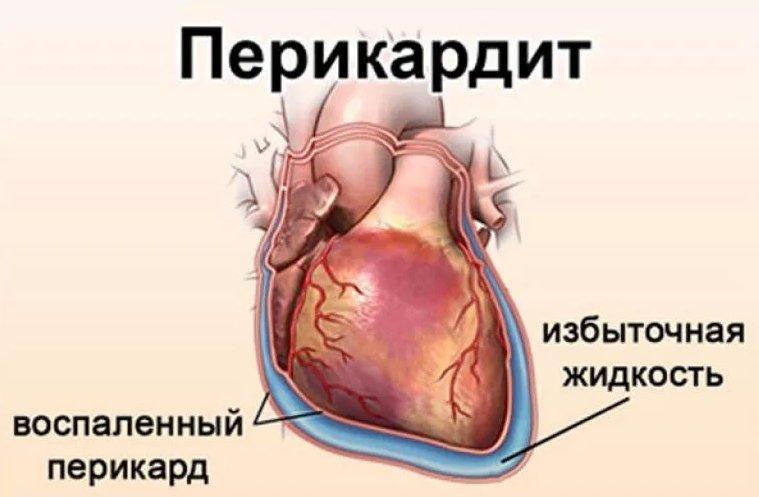 Воспалительное поражение серозной оболочки сердца