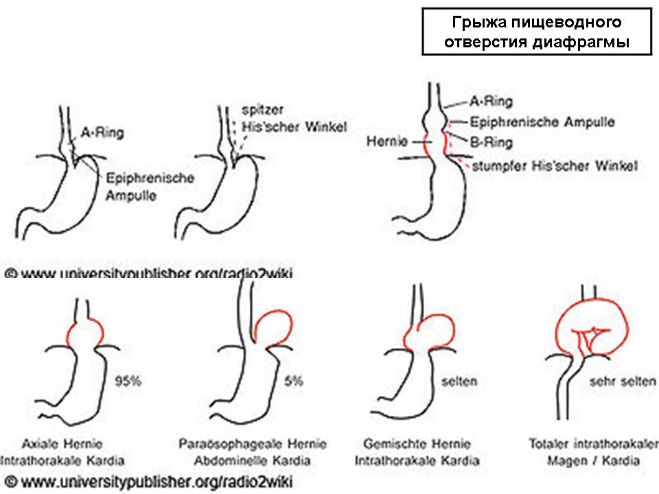 Каша при диафрагмальной грыже