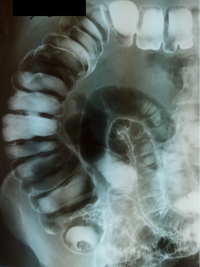 Где сделать ирригоскопию. Ирригоскопия Толстого кишечника рентген. Ирригоскопия кишечника видео. Симптом бычьего глаза при пилоростенозе. Ирригоскопия кишечника в Тюмени.