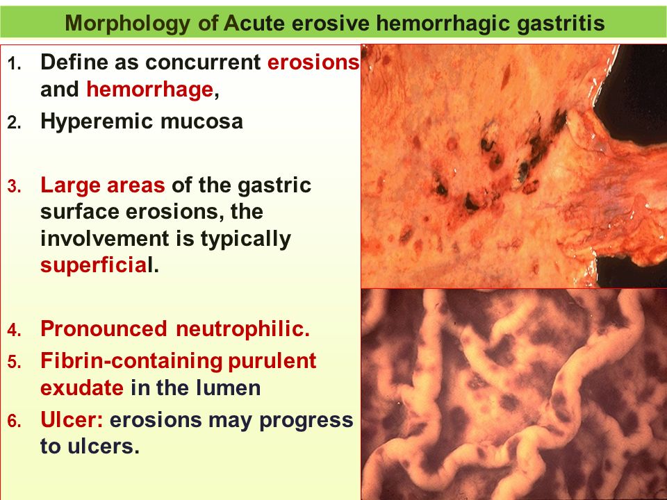 Morphology of Acute erosive hemorrhagic gastritis