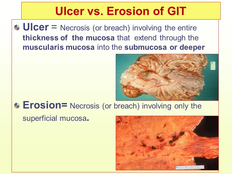 Ulcer vs. Erosion of GIT