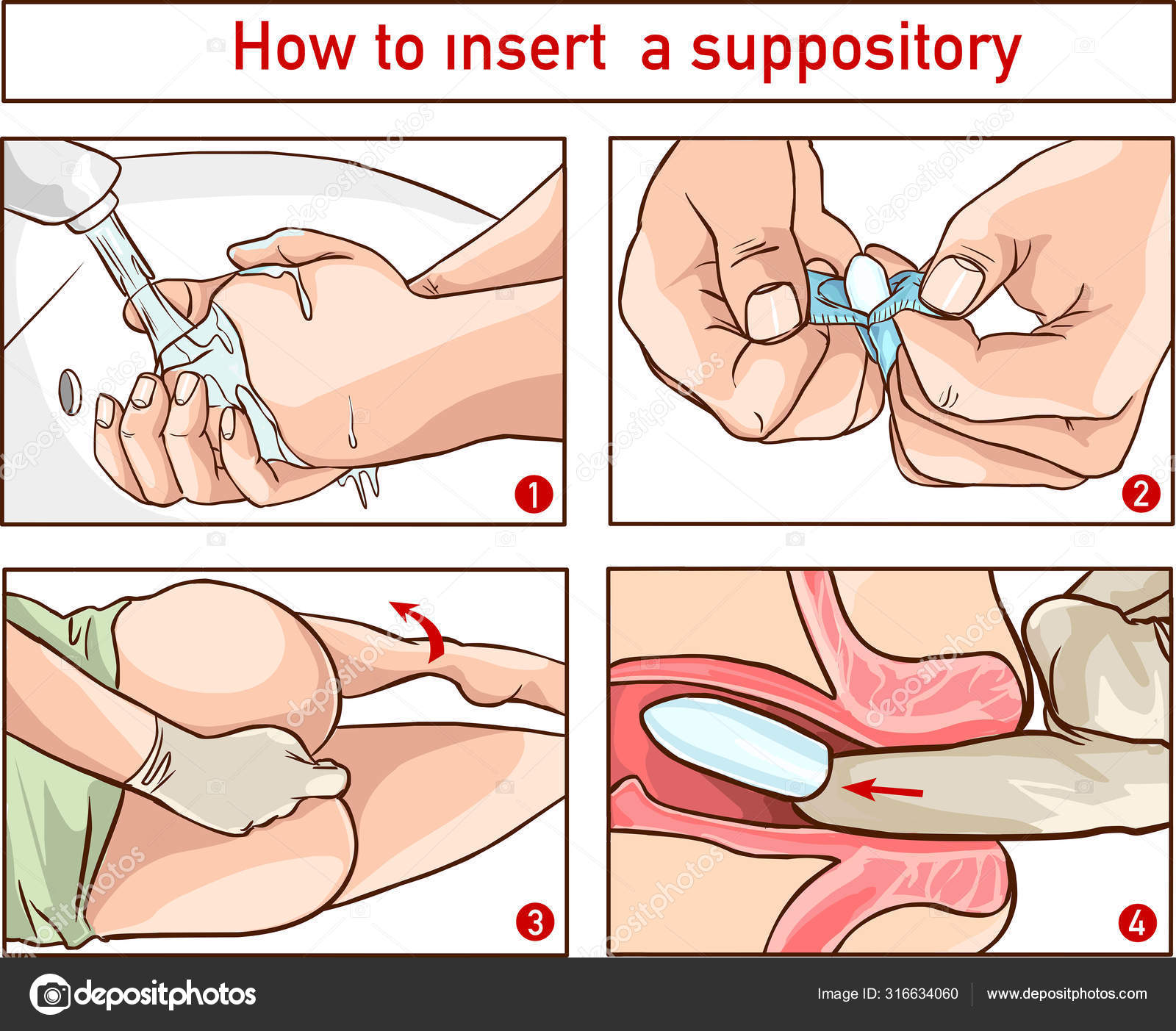 Как правильно вставлять свечи. Введение суппозитория в прямую кишку. Введение суппозитория в прямую кишку алгоритм. Введение интравагинально.