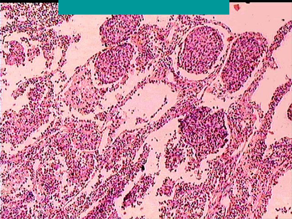 Низкодифференцированный плоскоклеточный рак. Плоскоклеточный неороговевающий. Плоскоклеточный Канцер g-1. Плоскоклеточная карцинома легкого микропрепарат. Плоскоклкточный раклегкого гистология.
