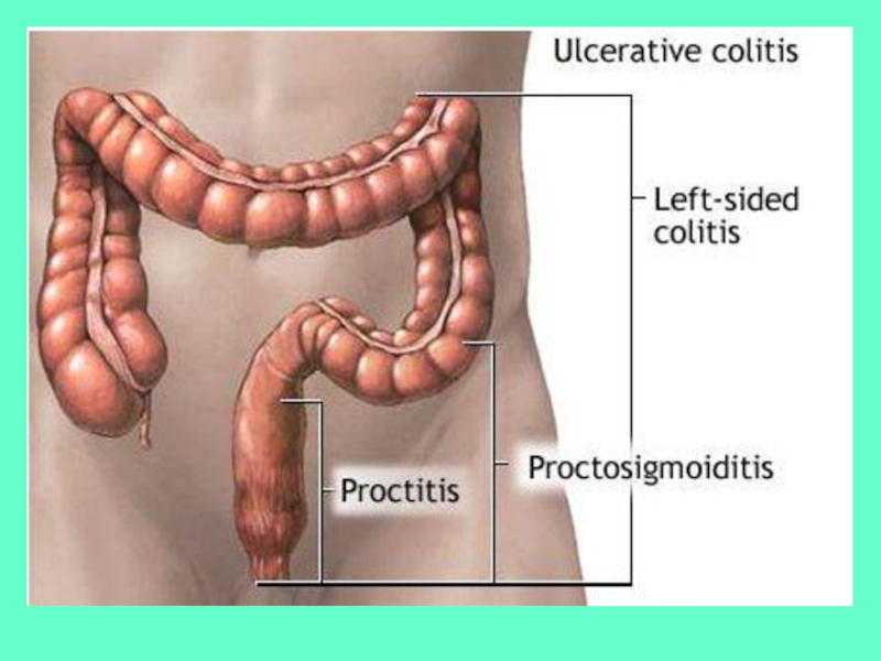 Лечение сигмовидной кишки. Воспаление прямой кишки (проктит). Воспаление толстой кишки.