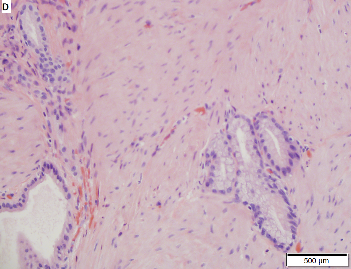 Extensive Rokitansky-Aschoff sinuses in a 64 year ood woman