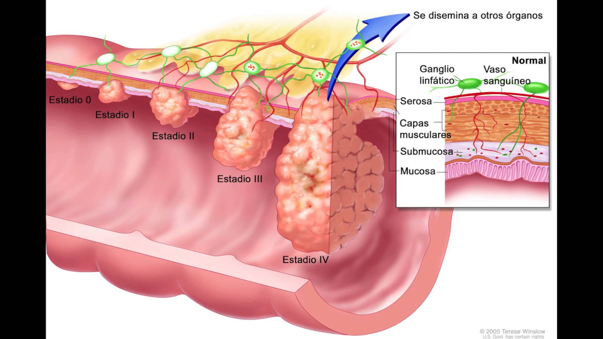 4 стадия рака кишки с метастазами. Опухолитолсктой кишки. Полипы Толстого кишечника. Полипоз кишечника симптомы.