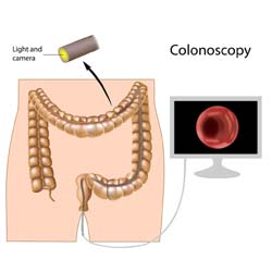 Colonoscopy - 8 Ways to Recover