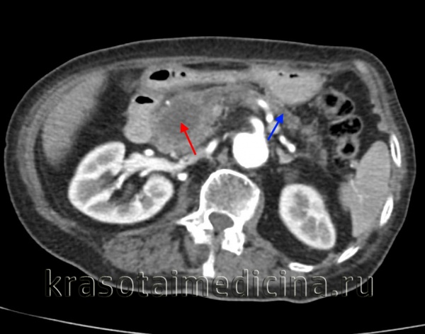КТ ОБП/ЗП. Гиподенсная опухоль в головке поджелудочной железы (красная стрелка) на фоне расширения главного панкреатического протока и атрофии дистальных отделов железы (синяя стрелка).