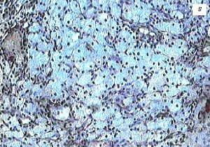 Микропрепарат, в структуре пенистые клетки, накопившие кристаллы холестерина, эфиры и желчные кислоты путем фагоцитоза, окраска гематоксилином и эозином