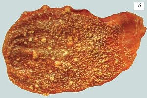 Макропрепарат, множественные выросты из подслизистого слоя и мелкие полипы на тонких ножках на фоне диффузной холестерозной сеточки