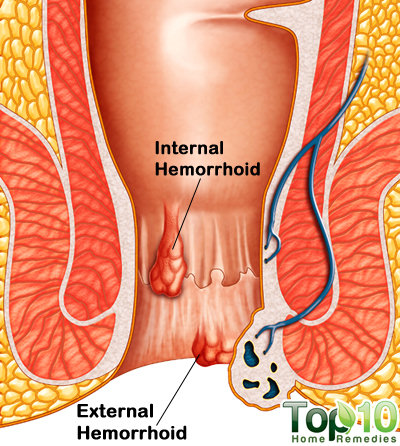hemorrhoids medical diagram