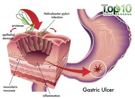 stomach ulcer diagram