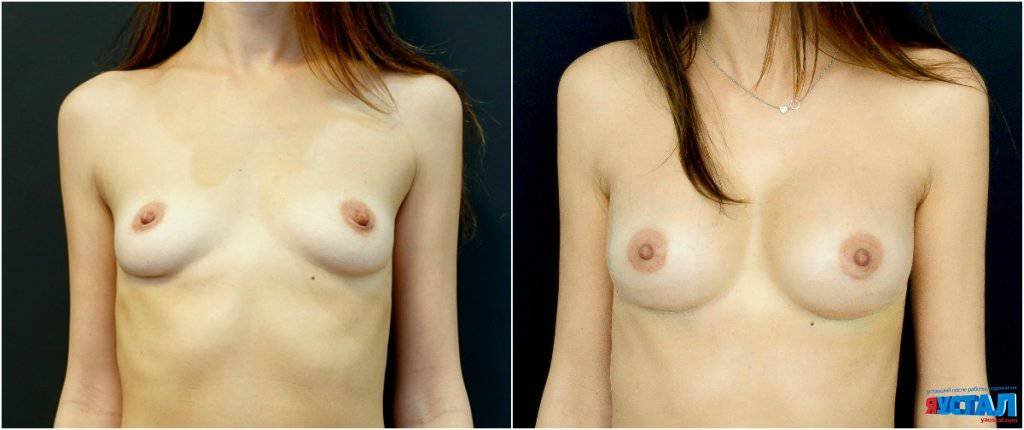 Как делают операцию по увеличению груди