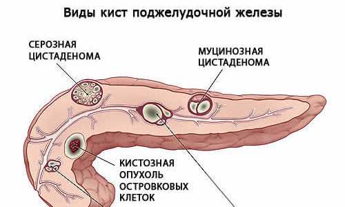 Фибролипоматоз поджелудочной железы что это. Цистаденома поджелудочной железы кт. Цистаденома головки поджелудочной железы на кт. Муцинозная опухоль поджелудочной железы на кт. Муцинозная цистаденома поджелудочной железы кт.